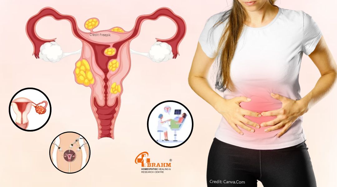 Causes of Uterine Fibroids